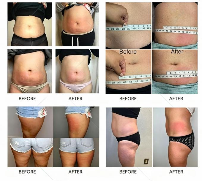 360Â° Cryolipolysis Machine | Professional Fat Freezing Body Slimming System for Salon 2
