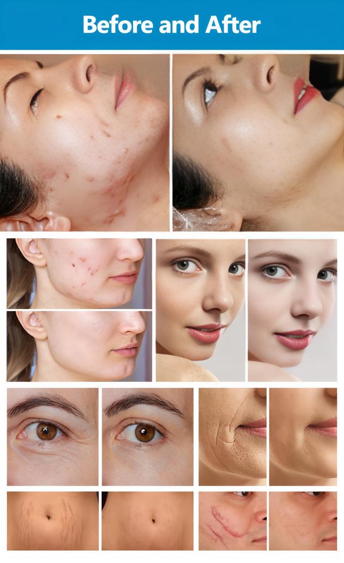 Professional 10.6 ÃÂ¼m Wavelength COÃÂ¢Ã¢â¬Å¡Ã¢â¬Å¡ Laser Device with Multi-Applicator Treatment System and 7 Programmable Scanning Patterns 4