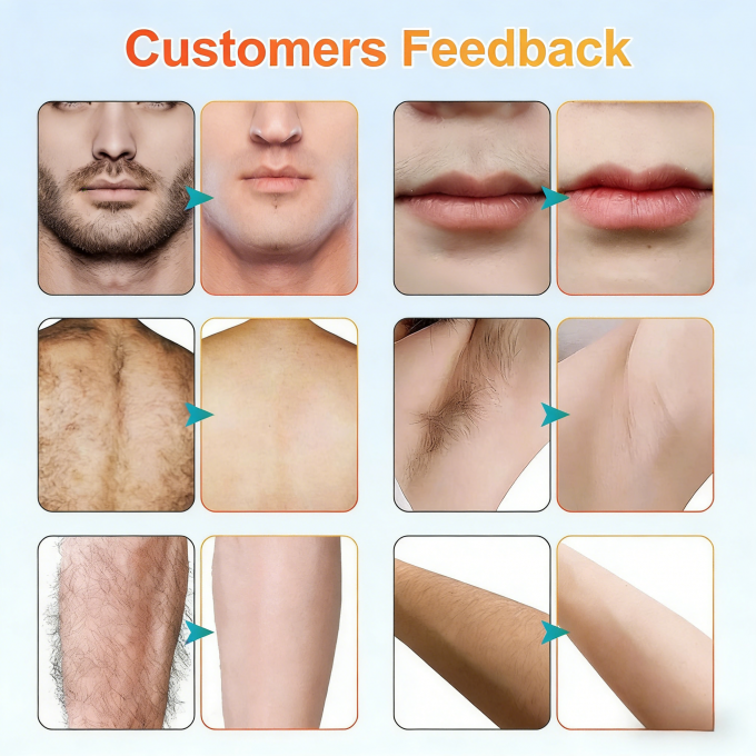 Professional Diode Laser Hair Removal Machine ÃÂ¢Ã¢âÂ¬Ã¢â¬Å Triple Wavelength 755/808/1064nm for Med Spa 5